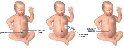 Пупкова грижа у новонароджених причини появи і лікування (грижа) Пупкова грижа у новонароджених причини появи і лікування