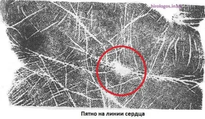 Пляма, острівці на лінії серця (початок лінії серця Бірла) Пляма, острівці на лінії серця