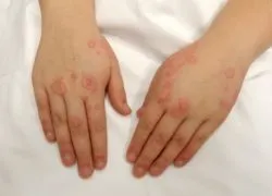Роздратування на руках