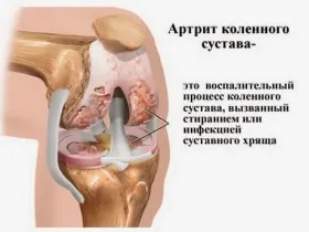 Реактивний артрит колінного суглоба симптоми і лікування (артрит) Реактивний артрит колінного суглоба симптоми і лікування