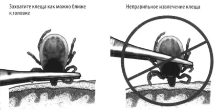 Дитину вкусив кліщ - що робити, симптоми, як витягнути в домашніх умовах, куди звертатися (кліщ) Дитину вкусив кліщ - що робити, симптоми, як витягнути в домашніх умовах, куди звертатися