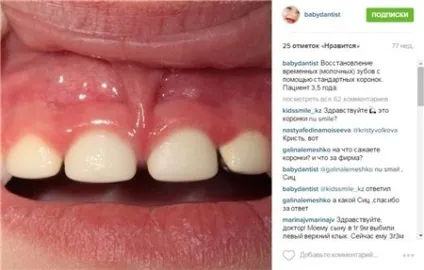 Дитині 4 верхні зуби згнили (дитині) Дитині 4 верхні зуби згнили