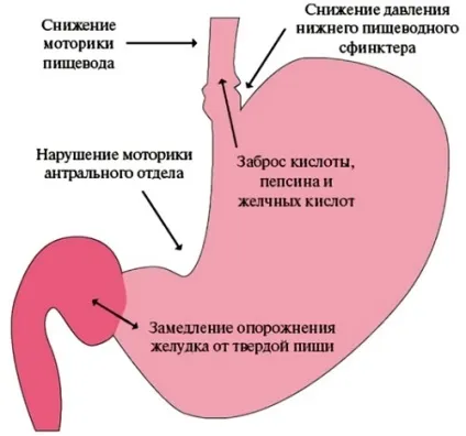 Рефлюкс езофагіт поширені симптоми і лікування у дітей (дітей) Рефлюкс езофагіт поширені симптоми і лікування у дітей