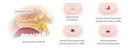 Ринолалія форми порушення, причини виникнення та лікування - наші дітки