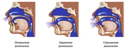 Ринолалія форми порушення, причини виникнення та лікування - наші дітки