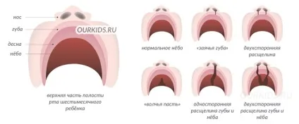 Ринолалія форми порушення, причини виникнення та лікування - наші дітки