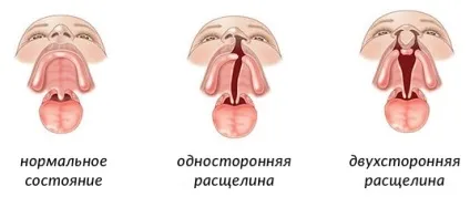 Ринолалія форми порушення, причини виникнення та лікування - наші дітки