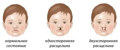Ринолалія форми порушення, причини виникнення та лікування - наші дітки