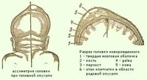Родова пухлина голови у новонароджених (новонароджених) Родова пухлина голови у новонароджених