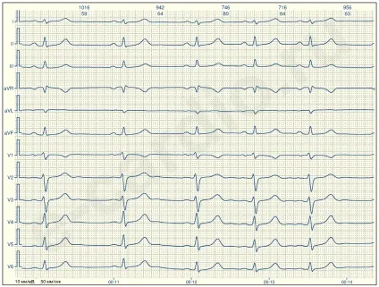 E-cardio урок 2 (синусовий-несінусовий)