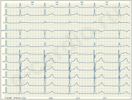 E-cardio урок 2 (синусовий-несінусовий)