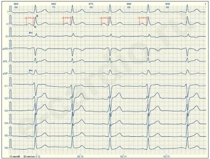 E-cardio урок 2 (синусовий-несінусовий)