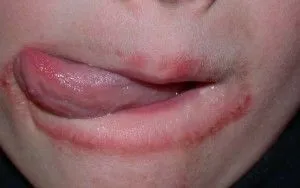 Стоматит у дорослих причини, профілактика і лікування (лікування) Стоматит у дорослих причини, профілактика і лікування