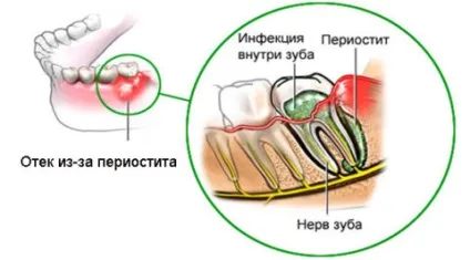 Шишка на яснах над зубом чому з'явилася і що робити (яснах) Шишка на яснах над зубом чому з'явилася і що робити