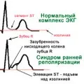 Синдром Фредеріка симптоми, лікування, ЕКГ ознаки