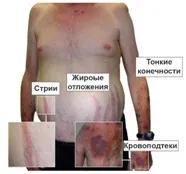 Синдром Іценко Кушинга що це таке