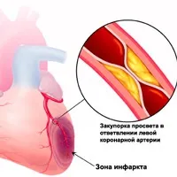 Синдром Фредеріка симптоми, лікування, ЕКГ ознаки