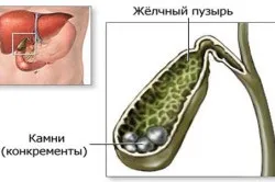 Симптоми захворювання печінки і жовчовивідних шляхів причини і лікування, дієти (відео) (перший по печінці) Симптоми захворювання печінки і жовчовивідних шляхів причини і лікування, дієти (відео)