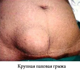 Симптоми пахової грижі всі характерні ознаки (грижі) Симптоми пахової грижі всі характерні ознаки