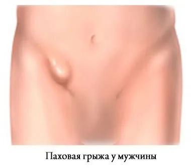 Симптоми пахової грижі всі характерні ознаки (симптоми) Симптоми пахової грижі всі характерні ознаки