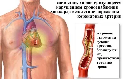 Синдром Фредеріка на ЕКГ симптоми і ознаки (симптоми) Синдром Фредеріка на ЕКГ симптоми і ознаки