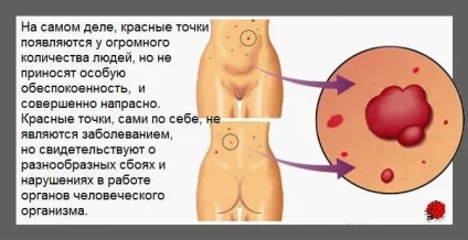 Висип у вигляді червоних крапок (точок) Висип у вигляді червоних крапок