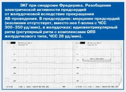 Синдром Фредеріка - причини, симптоми і лікування (лікування) Синдром Фредеріка - причини, симптоми і лікування