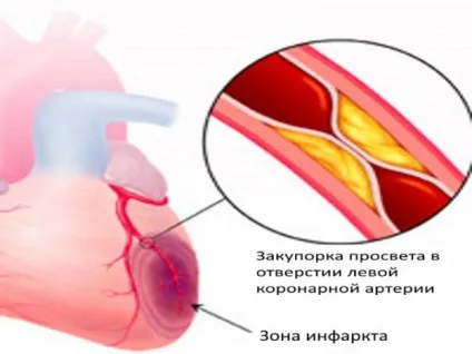 Синдром Фредеріка - причини, симптоми і лікування (лікування) Синдром Фредеріка - причини, симптоми і лікування