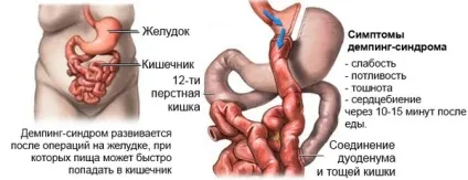 Слабкість після їжі