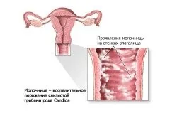 Поради жінкам спринцювання чистотілом (чистотілом) Поради жінкам спринцювання чистотілом