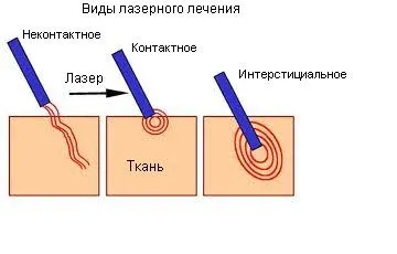 Сучасні методи лікування аденоми простати, мій уролог (методи) Сучасні методи лікування аденоми простати, мій уролог