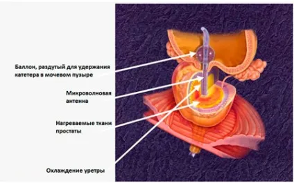 Сучасні методи лікування аденоми простати мають ряд переваг (сучасні) Сучасні методи лікування аденоми простати мають ряд переваг