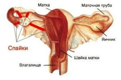 Спайки після кесаревого розтину, симптоми і лікування, як виглядають спайки і подальша вагітність (після) Спайки після кесаревого розтину, симптоми і лікування, як виглядають спайки і подальша вагітність