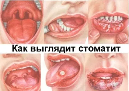 Стоматит на губі методи лікування в домашніх умовах (губі) Стоматит на губі методи лікування в домашніх умовах