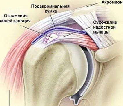 Тендиніт що це таке причини, симптоми, лікування тендиніту народними засобами