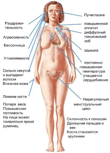 Тиреотоксичний криз - причини, симптоми і лікування (дифузний токсичний зоб) Тиреотоксичний криз - причини, симптоми і лікування