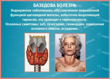 тиреотоксичний криз