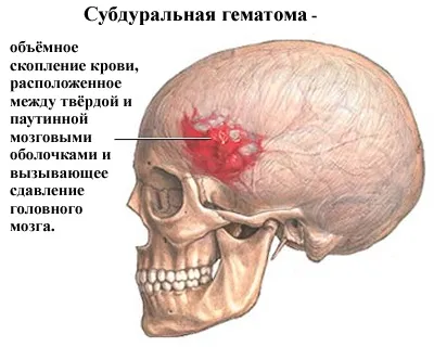 Трепанація при інсульті - лікування серця