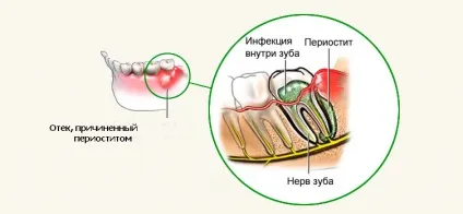 Тверда шишка на яснах - причини утворення (тверда) Тверда шишка на яснах - причини утворення