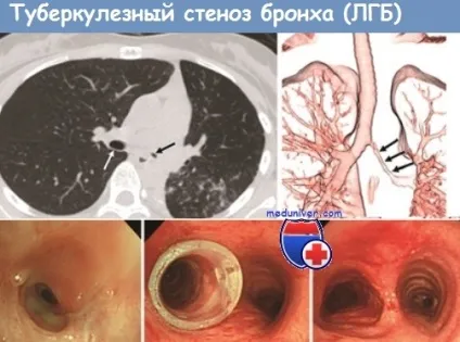 туберкульоз бронхів