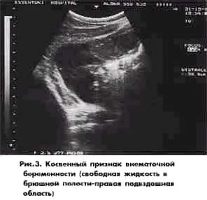 Ультразвукова діагностика позаматкової вагітності (ультразвукова) Ультразвукова діагностика позаматкової вагітності