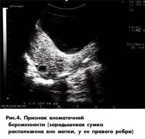 Ультразвукова діагностика позаматкової вагітності (ультразвукова діагностика) Ультразвукова діагностика позаматкової вагітності