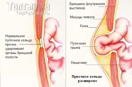 У дитини пупкова грижа, що робити - сайт про розвиток дитини (дитина) У дитини пупкова грижа, що робити - сайт про розвиток дитини