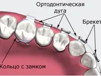 Пристрій брекет-систем