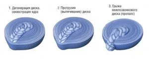 Узуратівние дефекти Шморля (узуратівние дефекти Шморля) Узуратівние дефекти Шморля