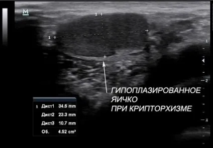 Узі яєчок у чоловіків що показує, як роблять, підготовка і розшифровка (чоловіків) Узі яєчок у чоловіків що показує, як роблять, підготовка і розшифровка