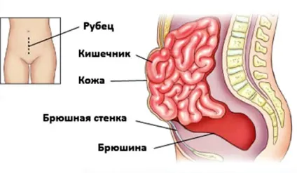 Вентральна післяопераційна грижа симптоми і лікування (лікування) Вентральна післяопераційна грижа симптоми і лікування