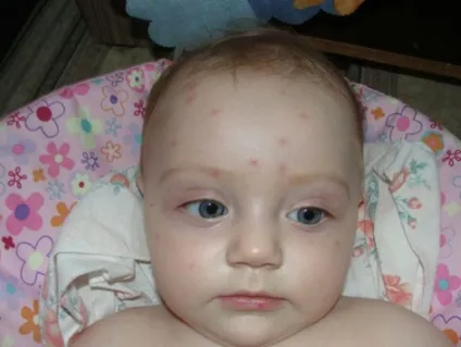 Везикулезная висип у дитини фото, що це таке, лікування (висип) Везикулезная висип у дитини фото, що це таке, лікування