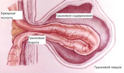 Види болю від пахової грижі (пахової) Види болю від пахової грижі