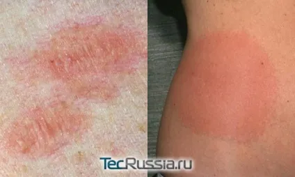 Види плям на шкірі, обличчі і тілі - фото і коментарі